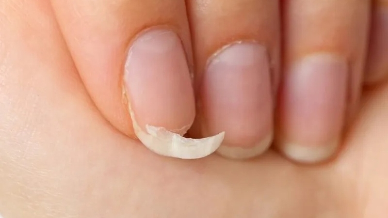 Nhìn móng tay đoán bệnh, bạn đã biết chưa? 3