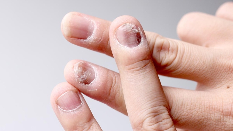 Nhìn móng tay đoán bệnh, bạn đã biết chưa? 4