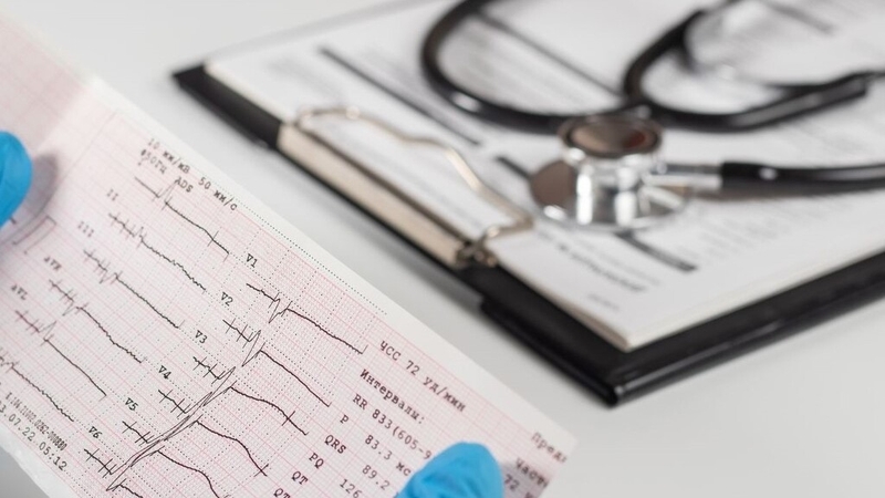 Nhịp nhanh QRS hẹp: Nguyên nhân, triệu chứng và cách điều trị hiệu quả 1