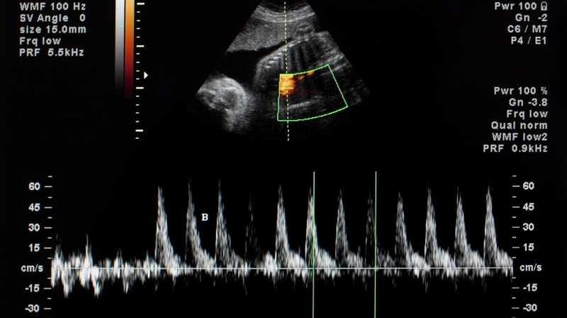 Nhịp tim thai 158 lần/phút là trai hay gái? Mẹo đoán giới tính thai nhi cực chuẩn 4