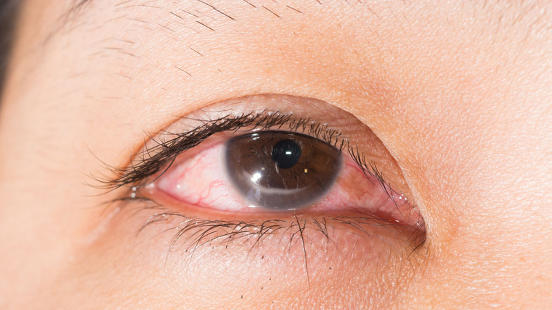 Nhỏ chanh vào mắt: Hậu quả khó lường cho đôi mắt! 1