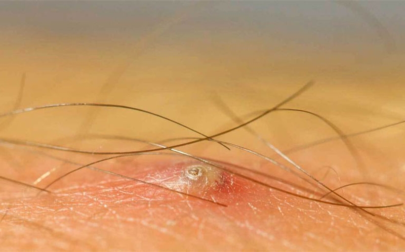 Wax lông bị lông mọc ngược phải làm sao?  1