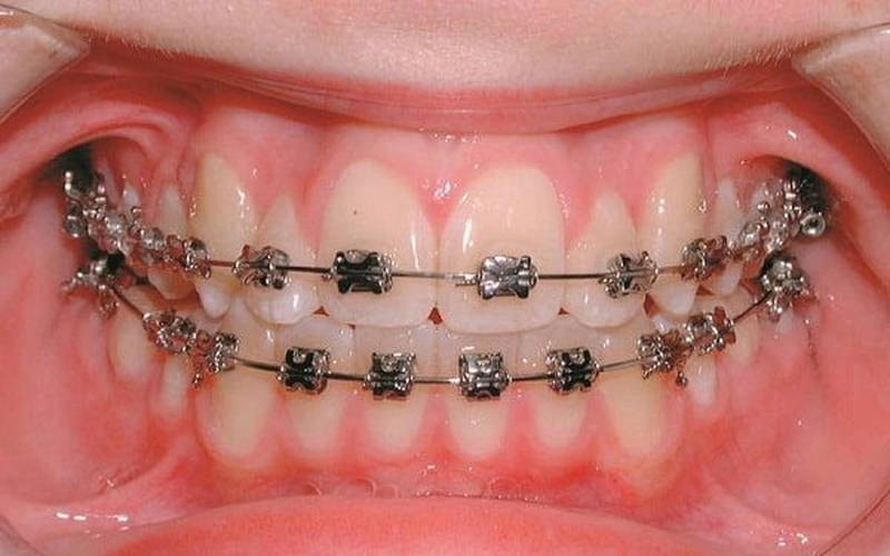 Nhổ răng ăn tôm được không? 2