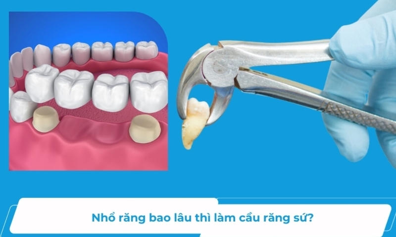 Nhổ răng bao lâu thì làm cầu răng được? Ưu và nhược điểm của phương pháp làm cầu răng 2
