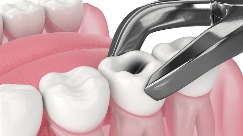 nho-rang-co-dau-khong-bi-quyet-giam-dau-hieu-qua 1