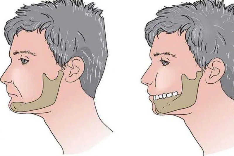 Trên thực tế, tình trạng hóp má sau khi nhổ răng khôn rất hiếm gặp