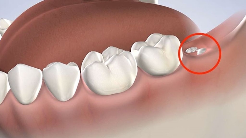 Nhổ răng khôn bằng máy Piezotome: Có gì khác biệt? 1