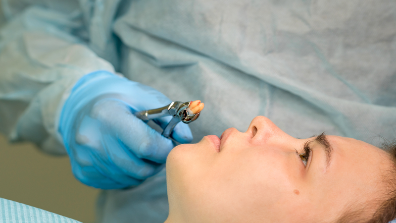 Kỹ thuật nhổ răng của bác sĩ ảnh hưởng rất lớn đến quá trình lành thương