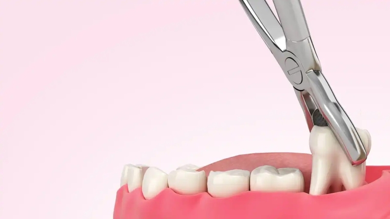 Nhổ răng không có cần phải nghỉ làm không? Các trường hợp đơn giản không cần nghỉ làm dài ngày
