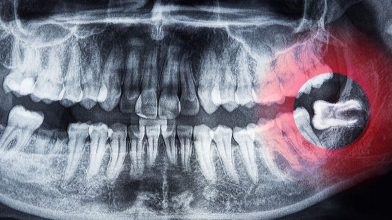 Nhổ răng khôn khi chúng mọc sai hướng