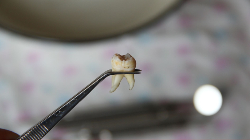 Nhổ răng khôn mất bao lâu phụ thuộc vào độ khó của răng