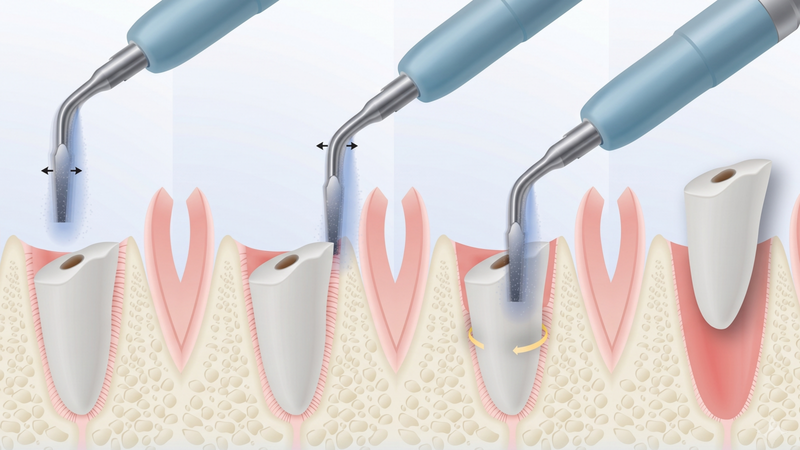 Nhổ răng khôn Piezotome nên được ưu tiên hơn nhổ răng khôn truyền thống