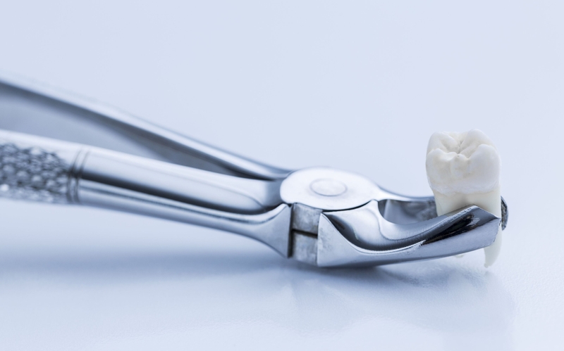 Nhổ răng khôn tiền mê là gì? Những lưu ý khi thực hiện 2