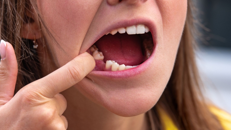 Nhổ răng không trồng lại có sao không?