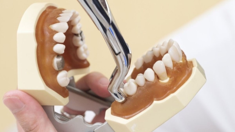 Nhổ răng nào nguy hiểm nhất? Lưu ý chăm sóc khi nhổ răng 1