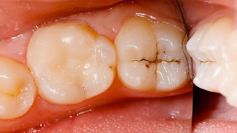 nho-rang-sau-nhung-dieu-can-biet-ve-sau-rang 1