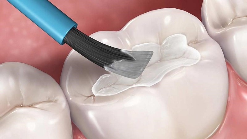 nho-rang-sau-nhung-dieu-can-biet-ve-sau-rang 2