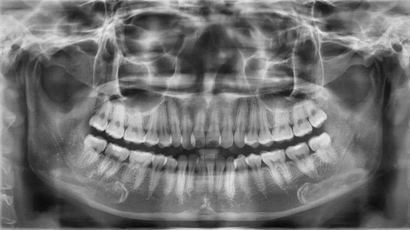 nho-rang-sau-nhung-dieu-can-biet-ve-sau-rang 3