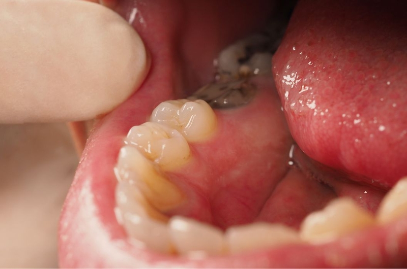 Tìm hiểu chi tiết về chỉ định nhổ răng số 6 hàm dưới 2