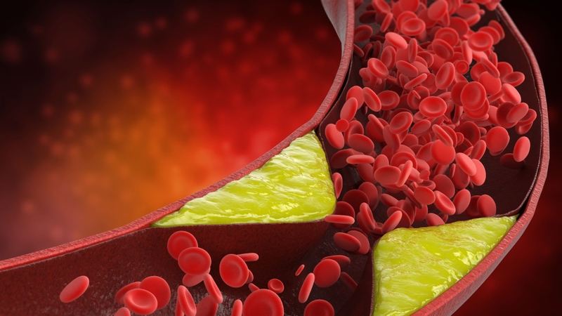 Nhồi máu cơ tim không ST chênh lên là bệnh lý gì? Có nguy hiểm không? 5