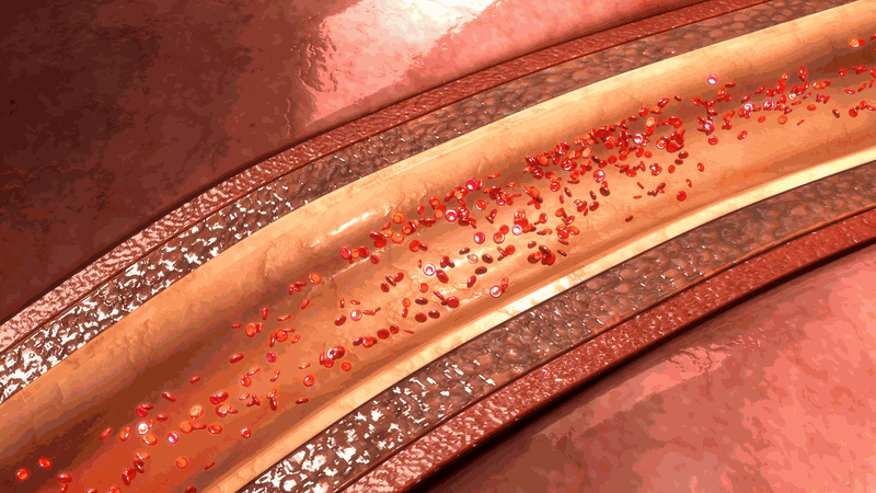 Nhồi máu động mạch mạc treo là gì? Những thông tin cần biết 1