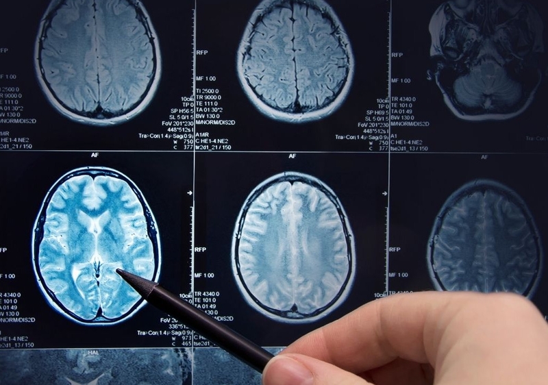 Nhồi máu não là gì? Các đặc điểm trên CT nhồi máu não không phải ai cũng biết 3