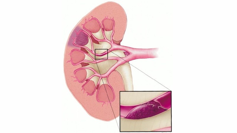 Nhồi máu thận là bệnh gì? Có nguy hiểm không? 1