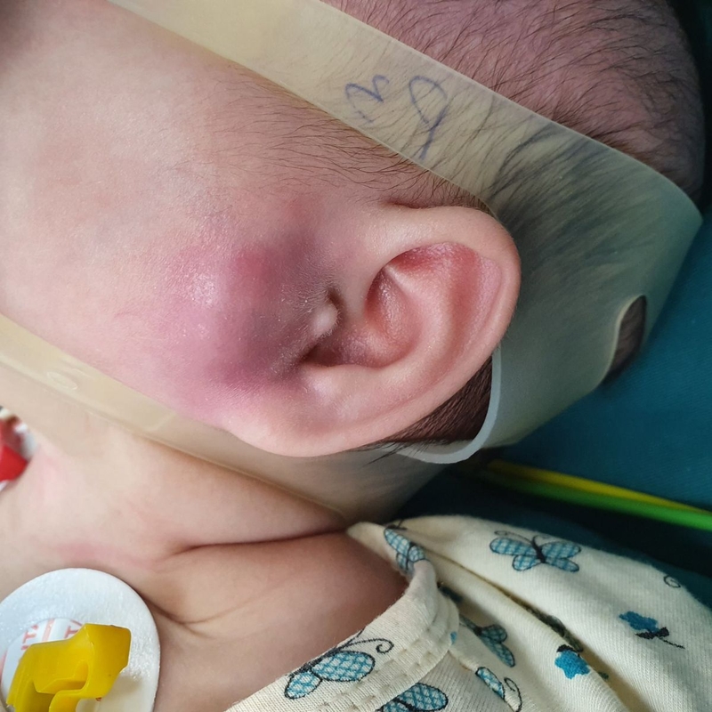 Nhọt ống tai ngoài ở trẻ sơ sinh: Bố mẹ không nên xem thường 1