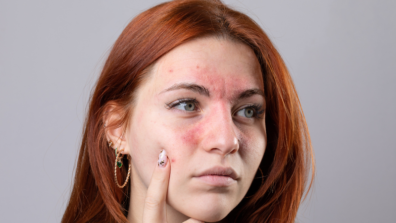 Ai dễ mắc bệnh Lupus? Nữ giới có nguy cơ mắc Lupus cao hơn nam giới