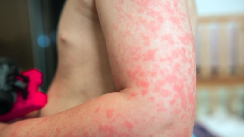 Những ai không nên ăn chuối tiêu? Thông tin bạn cần biết 4