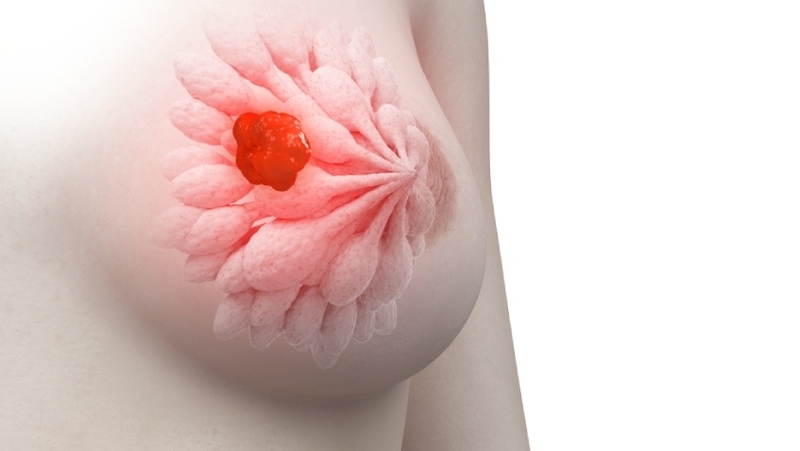 Những ai nên thực hiện xét nghiệm Oncotype DX 2