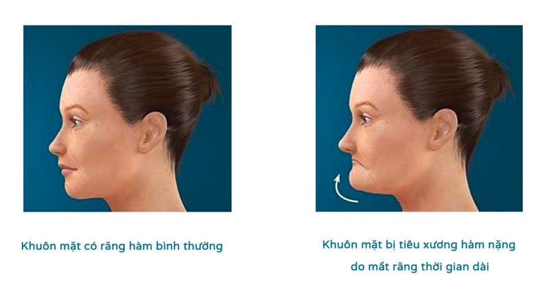 Những ảnh hưởng về sức khỏe của tiêu xương hàm 1