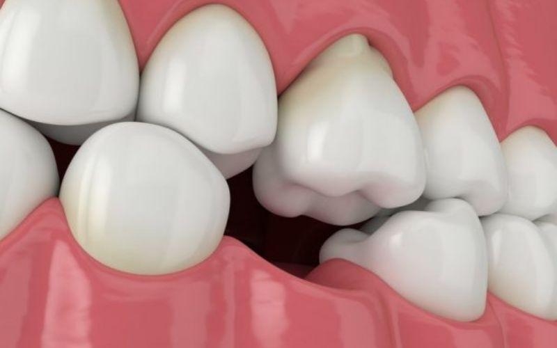 Những ảnh hưởng về sức khỏe của tiêu xương hàm 2