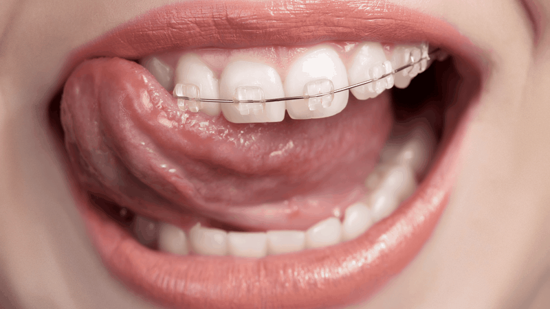 Các bài tập giảm hô hàm trên chỉ mang tính hỗ trợ chức năng, không thể thay thế phương pháp chỉnh nha hoặc điều trị chuyên sâu