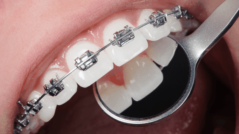 Niềng răng chỉnh nha là phương pháp phổ biến giúp điều chỉnh răng hô mức độ nhẹ đến trung bình, cải thiện khớp cắn, chức năng ăn nhai và thẩm mỹ khuôn mặt