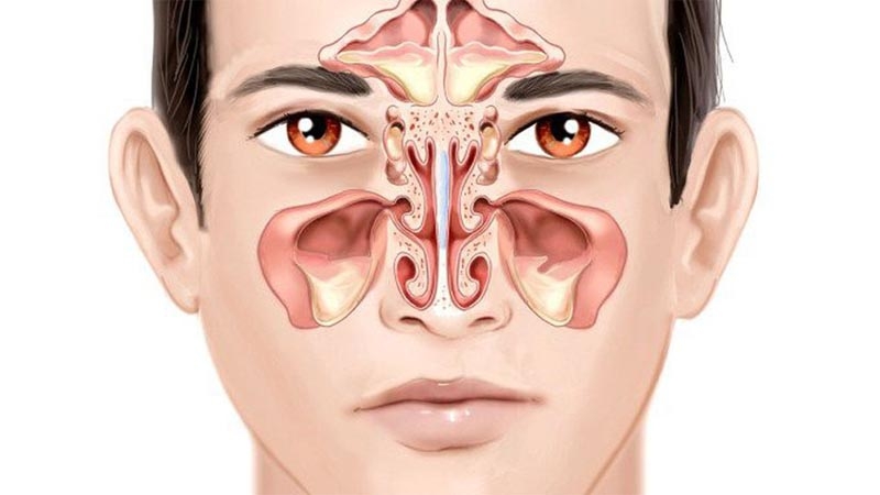 Những bài thuốc dân gian chữa viêm xoang mãn tính 1