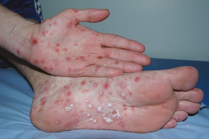 Những bài thuốc Đông y chữa bệnh giang mai ở nam và nữ hiệu quả 1