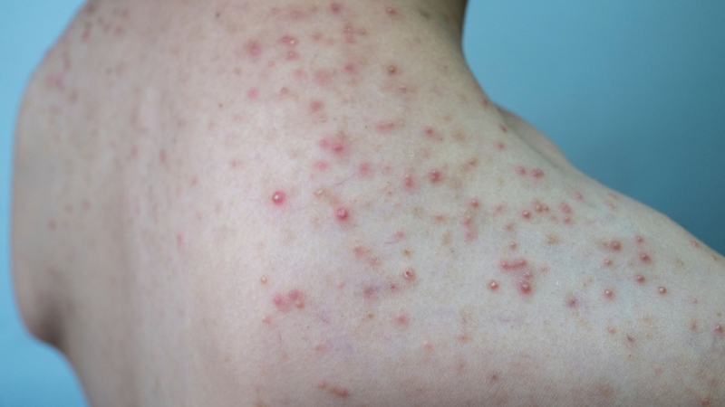 Môi trường nóng ẩm và quần áo bí dễ làm tăng nguy cơ viêm nang lông