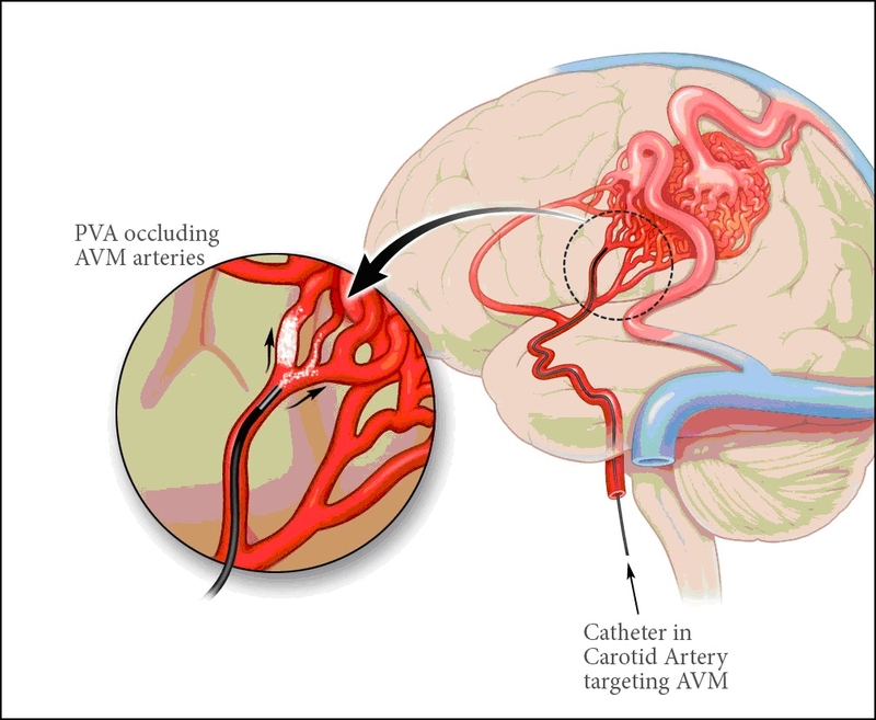 những biến chứng của bệnh tim mạch ở nam giới khó tránh khỏi