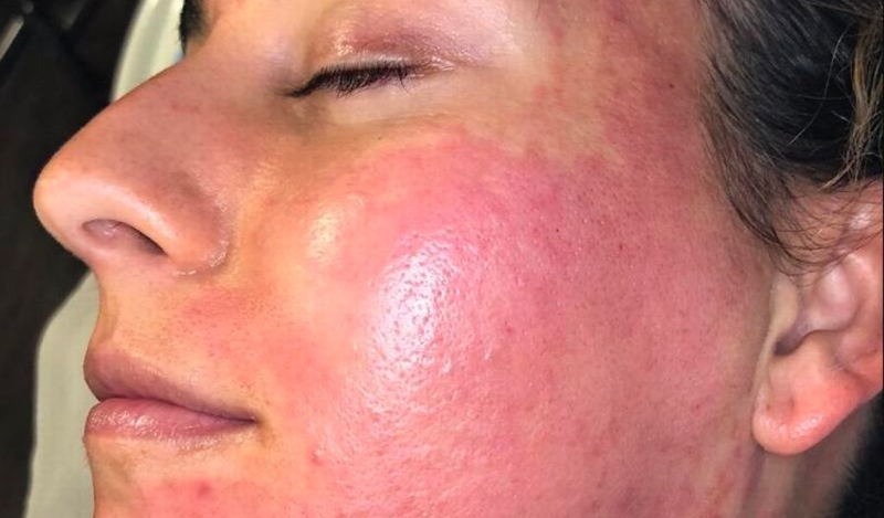 Những biến chứng của lăn kim? Nguyên nhân và cách phòng ngừa 3