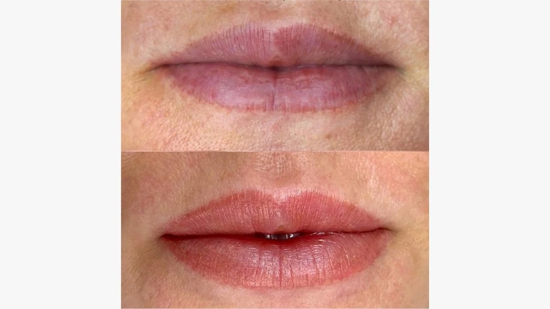 Những biến chứng xăm môi - Một vài lưu ý khi đi xăm môi 1