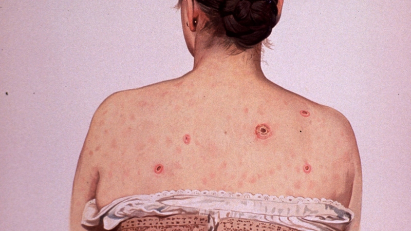 Ở giai đoạn muộn, bệnh giang mai có thể gây tổn thương nghiêm trọng đến sức khỏe