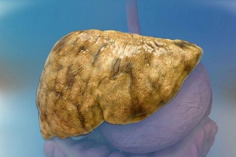 Những biểu hiện gan nhiễm mỡ bạn cần biết để nhận biết bệnh sớm 2