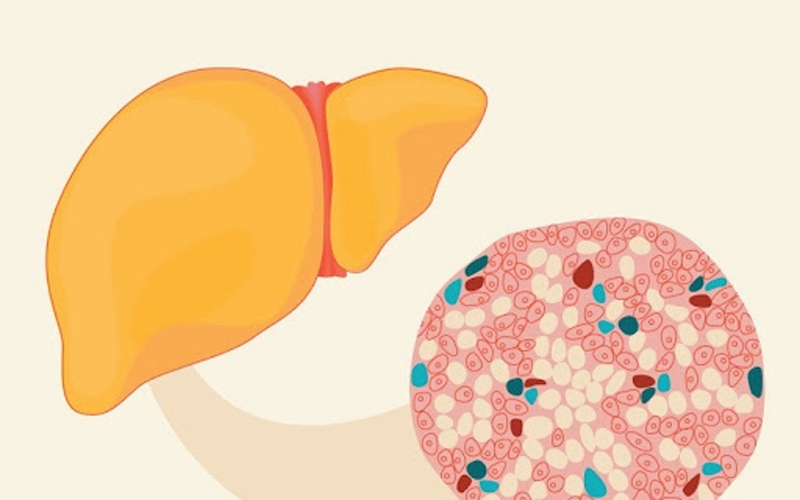 Những biểu hiện gan nhiễm mỡ bạn cần biết để nhận biết bệnh sớm 4
