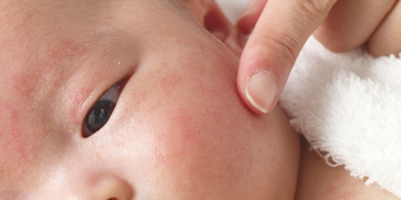 Những biểu hiện và nguyên nhân khiến trẻ bị rôm sảy 2