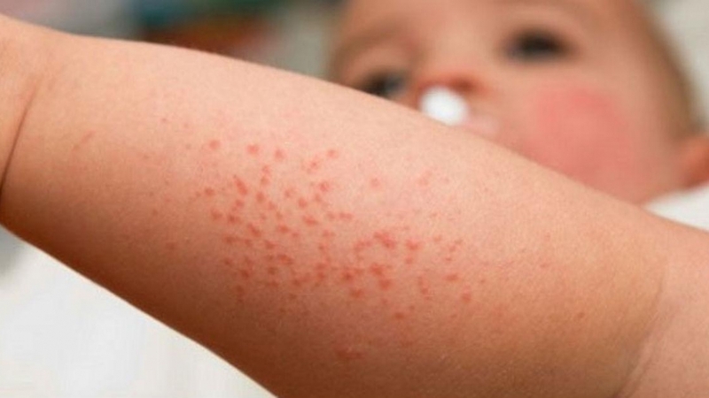 Những cách chữa trị rôm sảy cho trẻ tại nhà an toàn hiệu quả 1