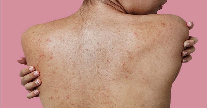 Những cách trị thâm mụn lưng lâu năm “thần tốc” 1