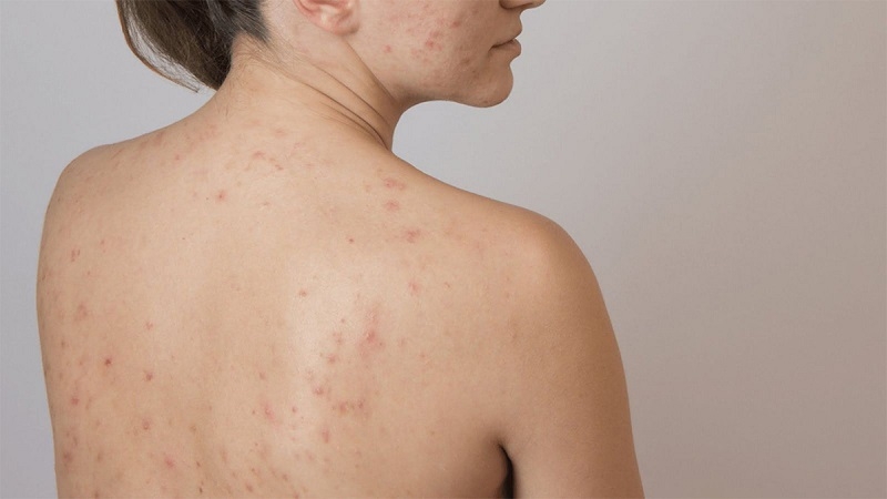 Những cách trị thâm mụn lưng tại nhà hiệu quả 1