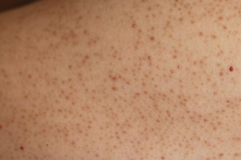 Da bị viêm nang lông