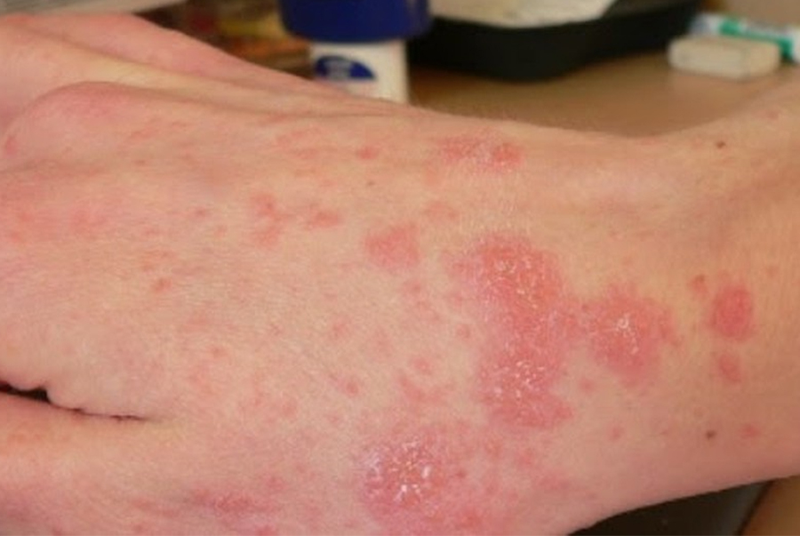 Triệu chứng dị ứng bao cao su: xuất hiện nhưng vết ban đỏ, mẩn ngứa